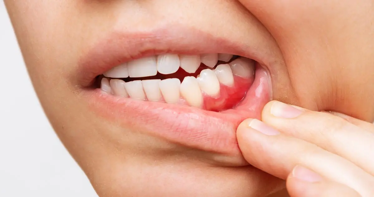 O que é a periodontite? Como se trata?