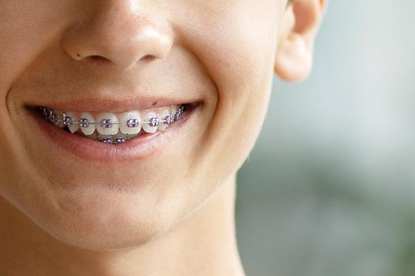 Ortodontia aparelho fixo Clinica São Dente dentista