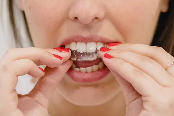 Ortodontia, alinhador invisível Invisalign