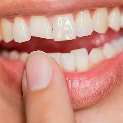 Fractura dentária